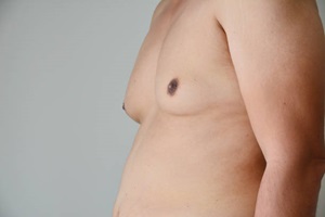 Gynaecomastia Surgery in Cheadle, UK by Dr Ayub 